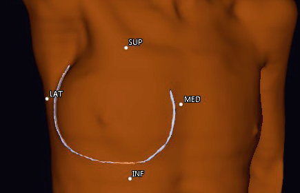 3D-view of a breast patient with the markers and wire that are automatically detected and that drive the algorithm